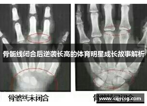 骨骺线闭合后逆袭长高的体育明星成长故事解析